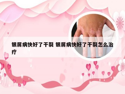 银屑病快好了干裂 银屑病快好了干裂怎么治疗