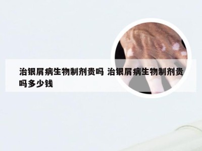 治银屑病生物制剂贵吗 治银屑病生物制剂贵吗多少钱