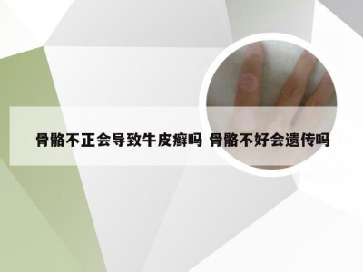 骨骼不正会导致牛皮癣吗 骨骼不好会遗传吗