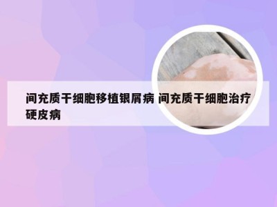 间充质干细胞移植银屑病 间充质干细胞治疗硬皮病