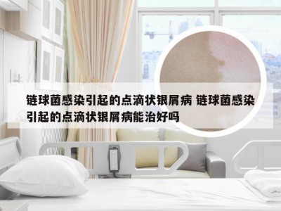 链球菌感染引起的点滴状银屑病 链球菌感染引起的点滴状银屑病能治好吗