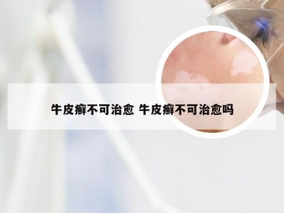 牛皮癣不可治愈 牛皮癣不可治愈吗