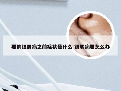 要的银屑病之前症状是什么 银屑病要怎么办