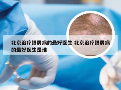 北京治疗银屑病的最好医生 北京治疗银屑病的最好医生是谁