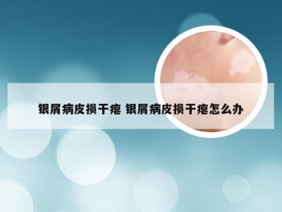 银屑病皮损干瘪 银屑病皮损干瘪怎么办