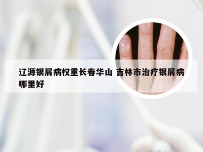 辽源银屑病权重长春华山 吉林市治疗银屑病哪里好