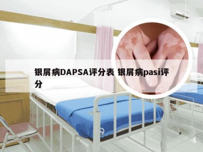 银屑病DAPSA评分表 银屑病pasi评分