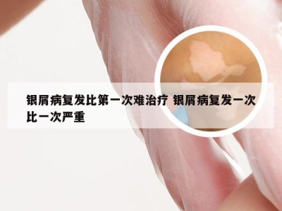 银屑病复发比第一次难治疗 银屑病复发一次比一次严重