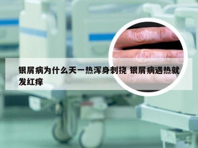 银屑病为什么天一热浑身刺挠 银屑病遇热就发红痒