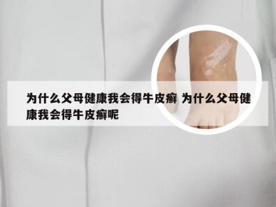 为什么父母健康我会得牛皮癣 为什么父母健康我会得牛皮癣呢