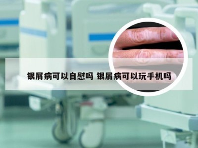 银屑病可以自慰吗 银屑病可以玩手机吗