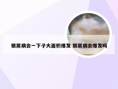 银屑病会一下子大面积爆发 银屑病会爆发吗