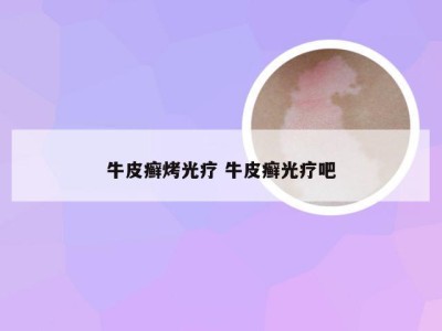 牛皮癣烤光疗 牛皮癣光疗吧