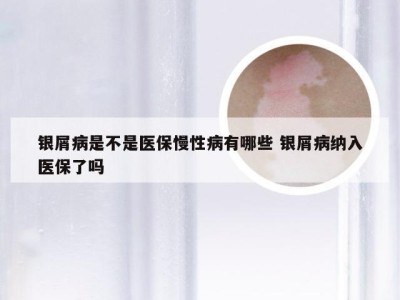 银屑病是不是医保慢性病有哪些 银屑病纳入医保了吗