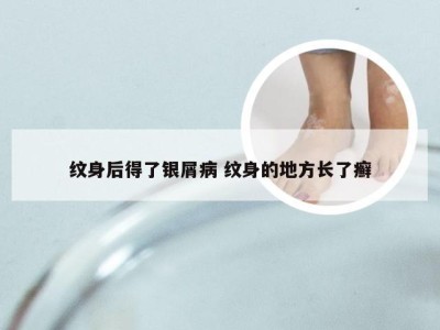 纹身后得了银屑病 纹身的地方长了癣
