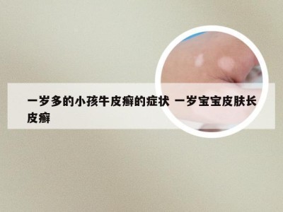 一岁多的小孩牛皮癣的症状 一岁宝宝皮肤长皮癣