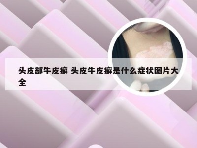 头皮部牛皮癣 头皮牛皮癣是什么症状图片大全