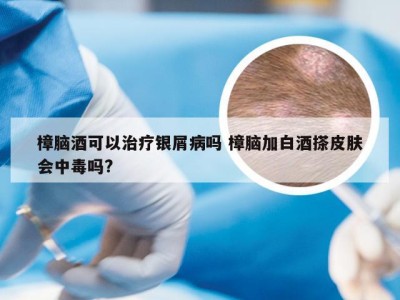 樟脑酒可以治疗银屑病吗 樟脑加白酒搽皮肤会中毒吗?