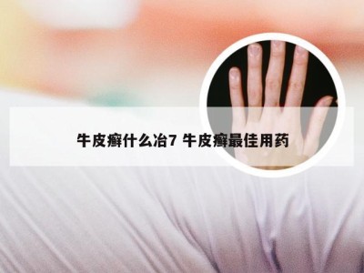 牛皮癣什么冶7 牛皮癣最佳用药