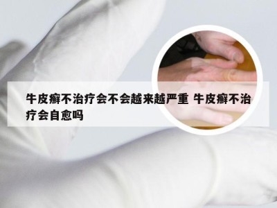 牛皮癣不治疗会不会越来越严重 牛皮癣不治疗会自愈吗