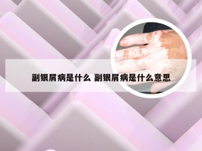 副银屑病是什么 副银屑病是什么意思