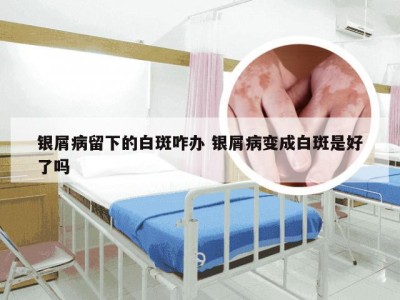 银屑病留下的白斑咋办 银屑病变成白斑是好了吗