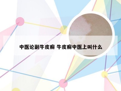 中医论副牛皮癣 牛皮癣中医上叫什么