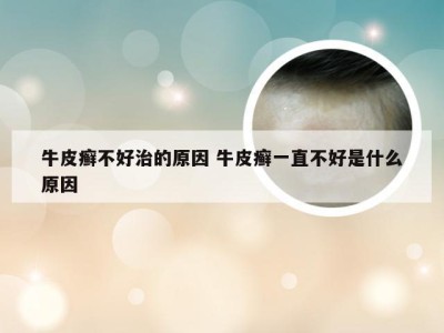 牛皮癣不好治的原因 牛皮癣一直不好是什么原因