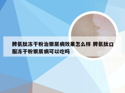 脾氨肽冻干粉治银屑病效果怎么样 脾氨肽口服冻干粉银屑病可以吃吗
