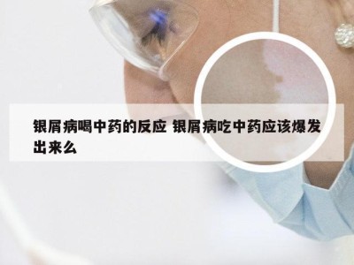 银屑病喝中药的反应 银屑病吃中药应该爆发出来么