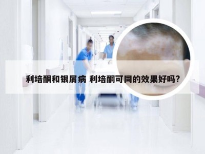 利培酮和银屑病 利培酮可同的效果好吗?