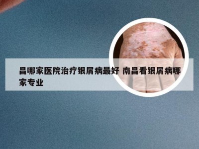 昌哪家医院治疗银屑病最好 南昌看银屑病哪家专业