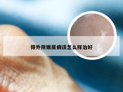 得外阴银屑病该怎么样治好