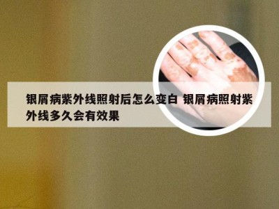 银屑病紫外线照射后怎么变白 银屑病照射紫外线多久会有效果