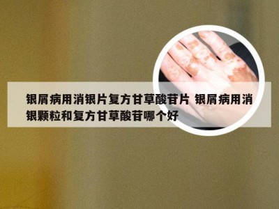 银屑病用消银片复方甘草酸苷片 银屑病用消银颗粒和复方甘草酸苷哪个好