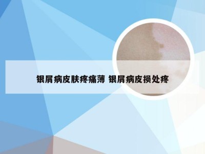 银屑病皮肤疼痛薄 银屑病皮损处疼