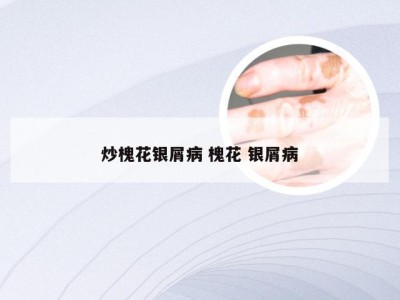 炒槐花银屑病 槐花 银屑病