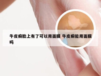 牛皮癣脸上有了可以用面膜 牛皮癣能用面膜吗