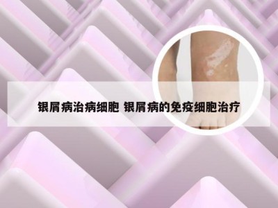 银屑病治病细胞 银屑病的免疫细胞治疗