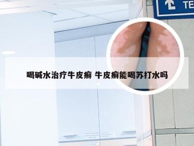 喝碱水治疗牛皮癣 牛皮癣能喝苏打水吗