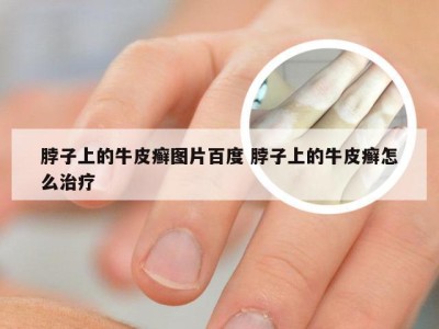 脖子上的牛皮癣图片百度 脖子上的牛皮癣怎么治疗