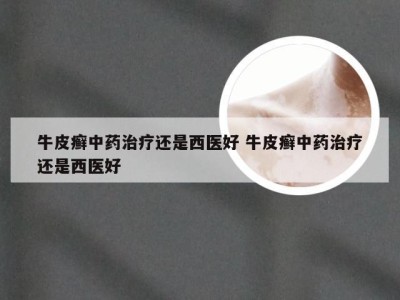 牛皮癣中药治疗还是西医好 牛皮癣中药治疗还是西医好