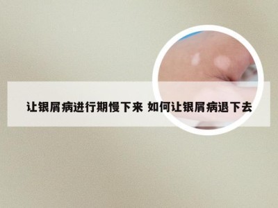 让银屑病进行期慢下来 如何让银屑病退下去