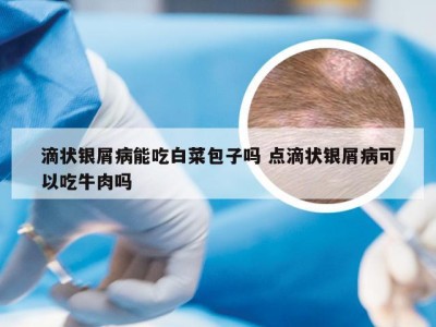 滴状银屑病能吃白菜包子吗 点滴状银屑病可以吃牛肉吗