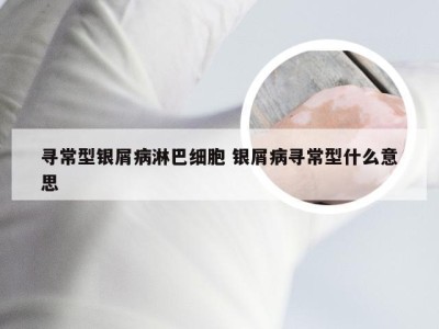 寻常型银屑病淋巴细胞 银屑病寻常型什么意思
