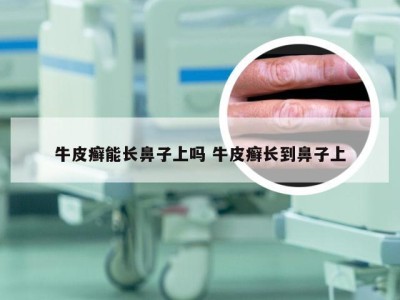 牛皮癣能长鼻子上吗 牛皮癣长到鼻子上