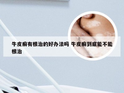 牛皮癣有根治的好办法吗 牛皮癣到底能不能根治