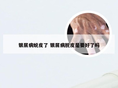 银屑病蜕皮了 银屑病脱皮是要好了吗