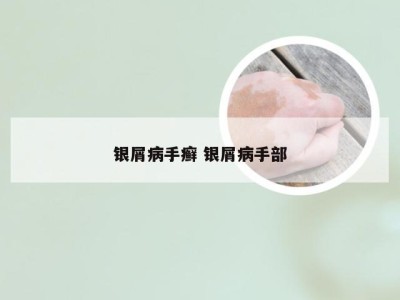银屑病手癣 银屑病手部