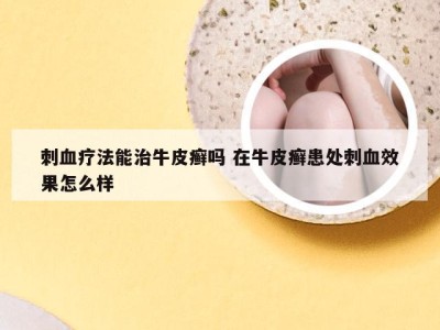 刺血疗法能治牛皮癣吗 在牛皮癣患处刺血效果怎么样